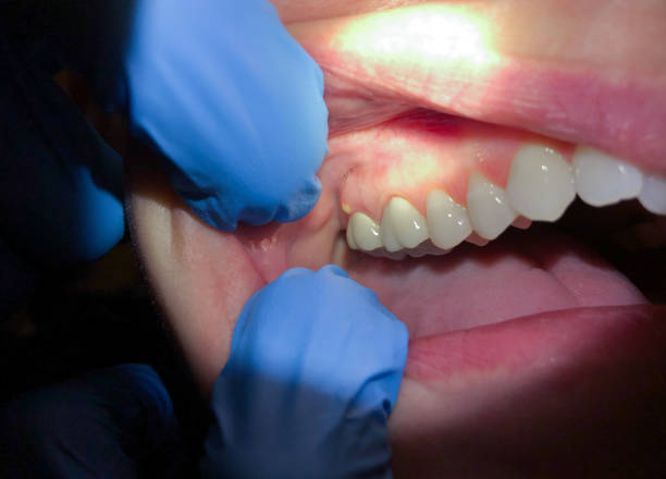 Best Emergency Dental Care for Broken or Chipped Teeth in Oakland, SC